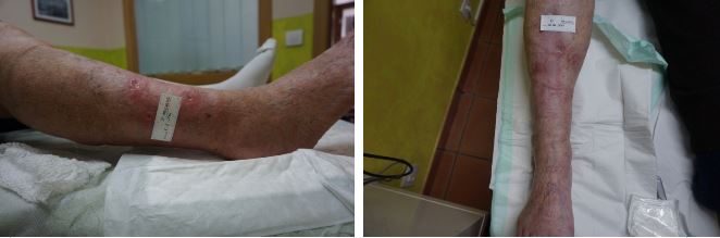 Cicatrización de úlceras con k-Láser en clínicas CMUC