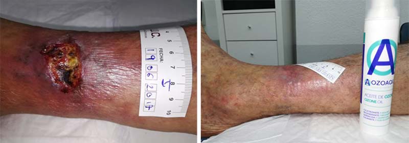 patalogia-vascular-curacion-con-ozono-en-CMUC