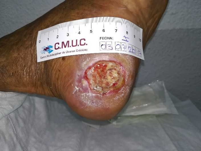 Úlcera antes de colocar la TPNT