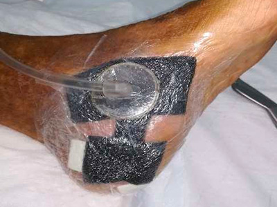 Úlcera con la TPNT colocada