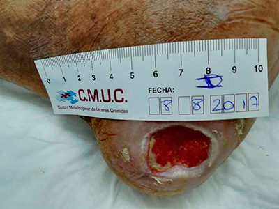 Úlcera tras sesión TPNT