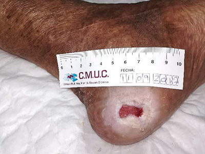 Úlcera tras 1 mes de TPNT