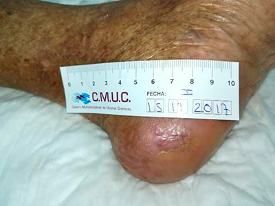 Úlcera tras 3 meses de TPNT