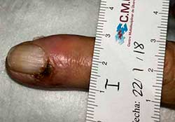 trombosis inflamatoria miembros supeiores