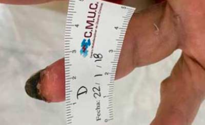 úlceras isquémicas angeíticas