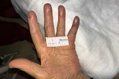 tromboangeitis obliterante o enfermedad de buerger