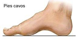 pies cavos