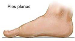 pies planos