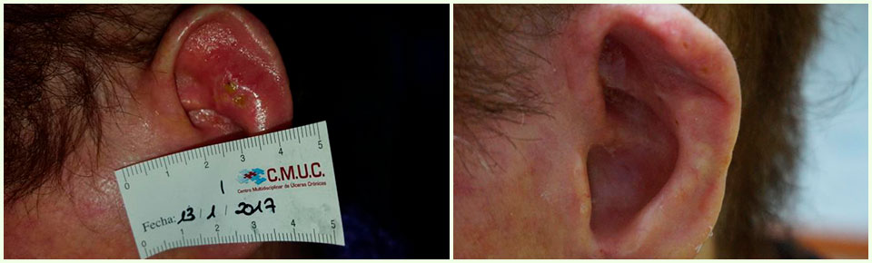 aceite-de-ozono-esclerodermia-tratamiento-cmuc