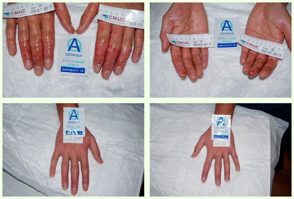 aceite-ozono-dermatitis-atopica-tratamiento-cmuc