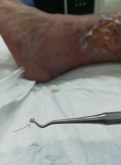 Depósitos de calcio