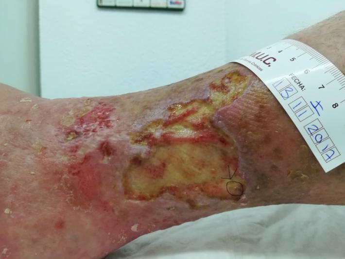 Depósito desbridado