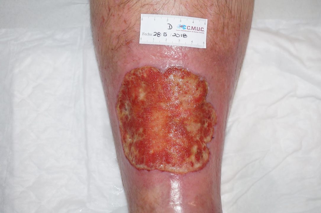 Vasculitis presentada en consulta CMUC España