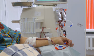 SINDROME DE ROBO POR FÍSTULA ARTERIO-VENOSA