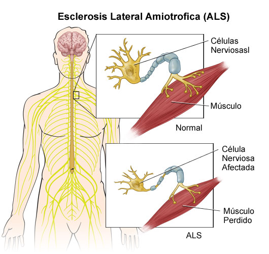esquema esclerosis lateral amiotrófica