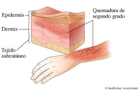 quemadura6