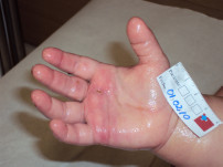 Al cabo de un mes, terminamios las curas con acidos grasos hiperoxigenados.