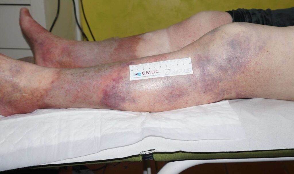 hematoma en la pierna