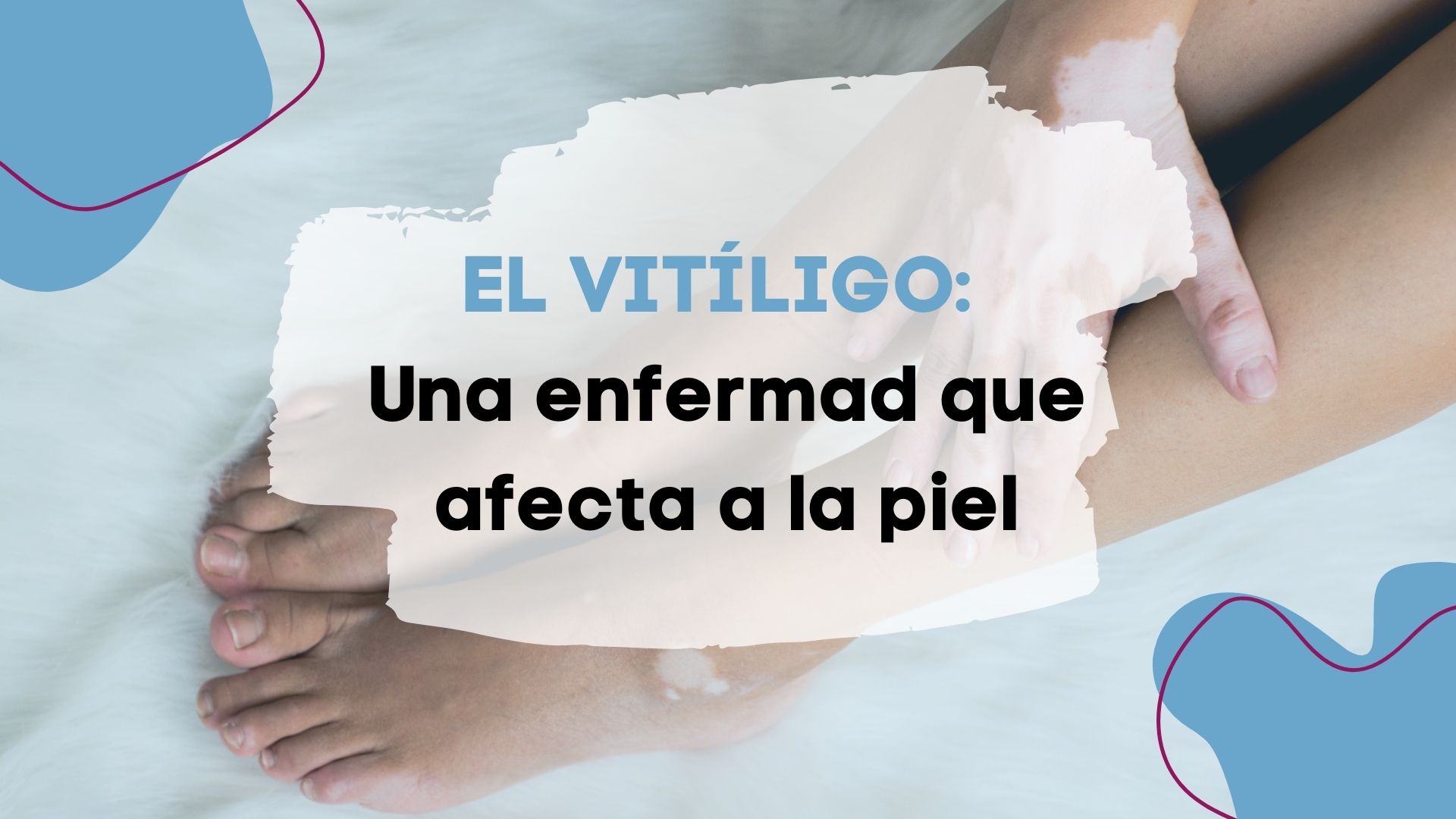 Piernas cansadas, con la fitoterapia puede ayudar a cuidar la salud - Salud  de Mujer Magazine